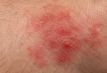 Anvisa autoriza novo uso do Gazya contra lúpus eritematoso sistêmico
