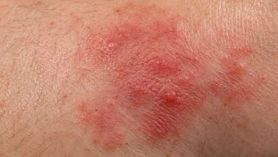 Anvisa autoriza novo uso do Gazya contra lúpus eritematoso sistêmico